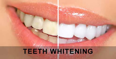 Teeth whitening2